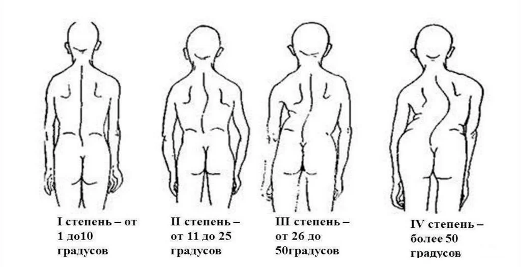 Степени сколиоза Степени сколиоза