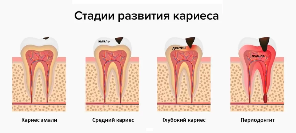 Стадии-кариеса Стадии-кариеса