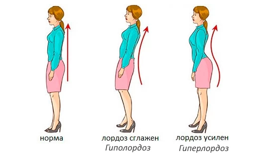 Виды лордоза